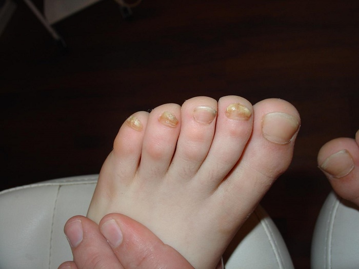 Грибок ногтей на ногах у ребенка