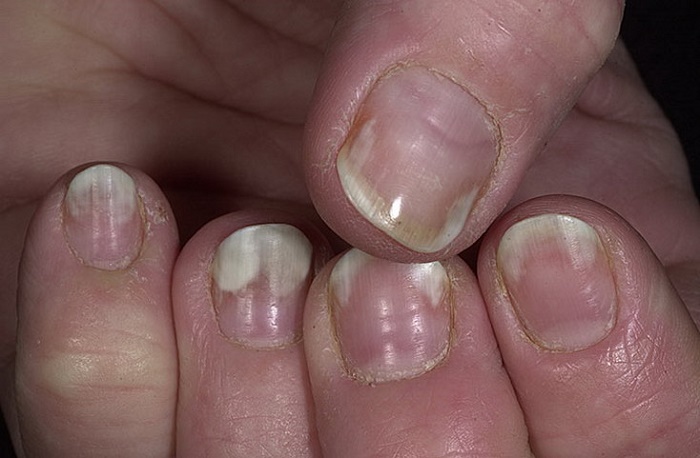 Грибок ногтей симптомы